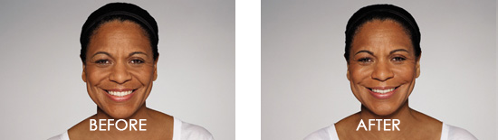 Dysport Before After 04