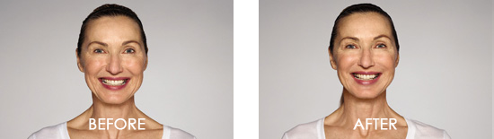 Dysport Before After 06