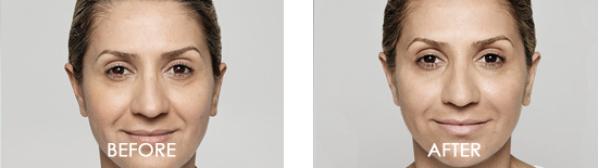 Dysport Before After 10