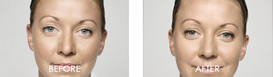 Dysport Before After 07