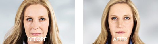 Dysport Before After 08