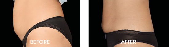 Emsculpt Before After 01