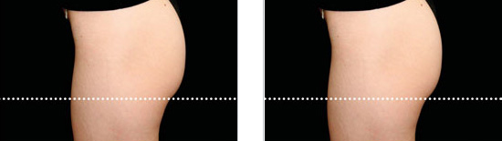 Emsculpt Before After 02