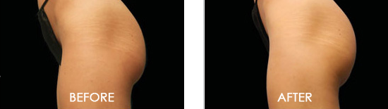 Emsculpt Before After 03