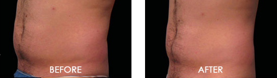 Emsculpt Before After 04