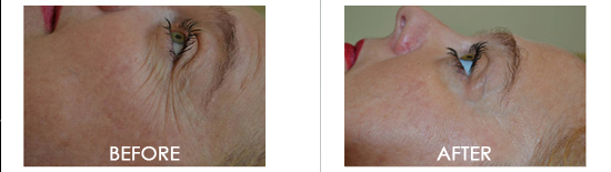 Exilis Ultra Before After 01