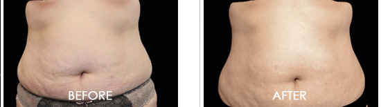 Exilis Ultra Before After 02