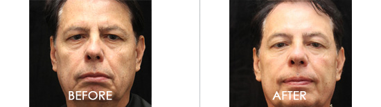 Exilis Ultra Before After 03