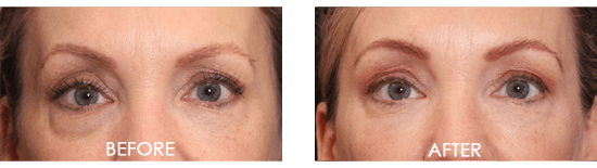 Facial Skin Tightening Before After 01