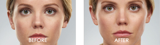 Juvederm Before After 01