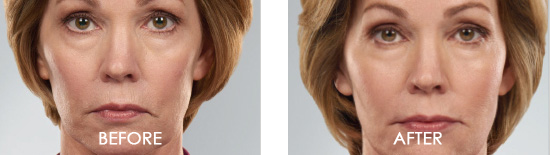 Juvederm Before After 02