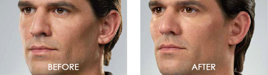 Juvederm Before After 03