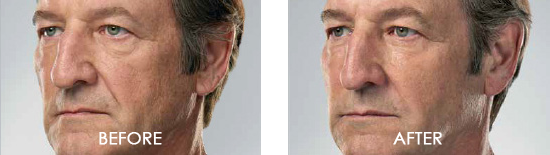 Juvederm Before After 04