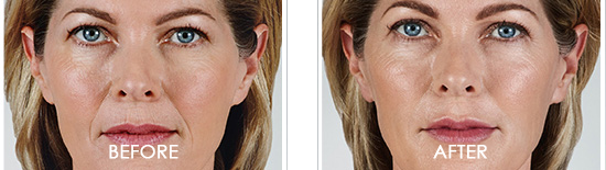 Juvederm Before After 05