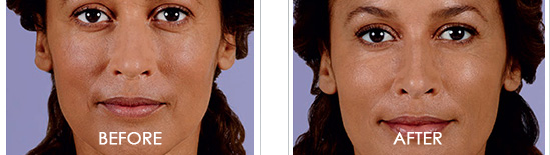 Juvederm Before After 06