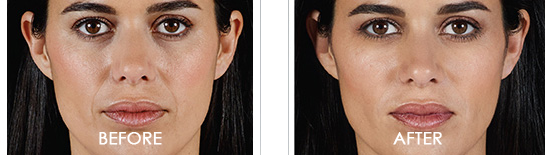 Juvederm Before After 07