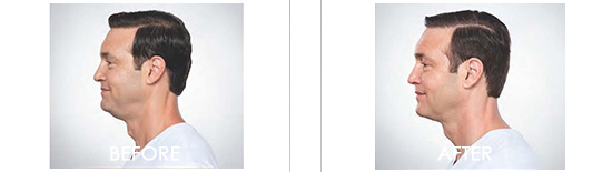 Kybella Before After 02