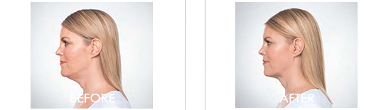 Kybella Before After 04