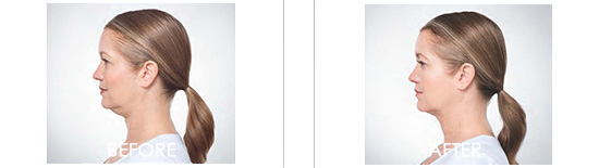 Kybella Before After 05