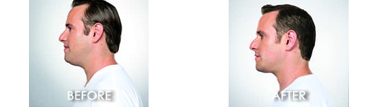 KYBELLA™ Before After 07