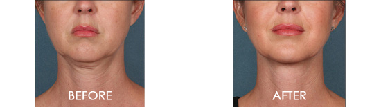Kybella Chin Contouring Before After 01