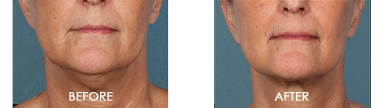 Kybella Chin Contouring Before After 02