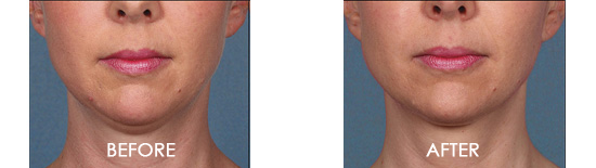 Kybella Chin Contouring Before After 03