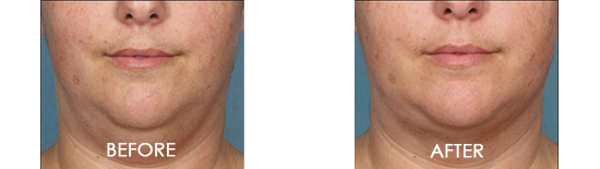 Kybella Chin Contouring Before After 04