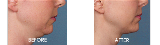 Kybella Chin Contouring Before After 05