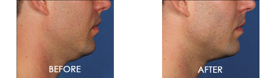 Kybella Chin Contouring Before After 06