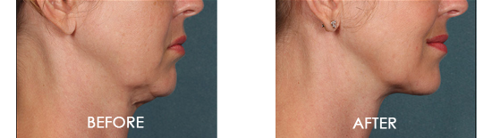 Kybella Chin Contouring Before After 07
