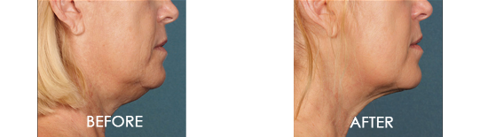 Kybella Chin Contouring Before After 08