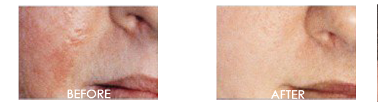 Skin Micro-Dermabrasion or Exfoliation Before After 01