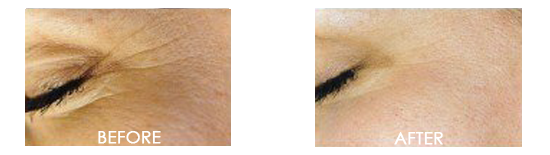 Skin Micro-Dermabrasion or Exfoliation Before After 02