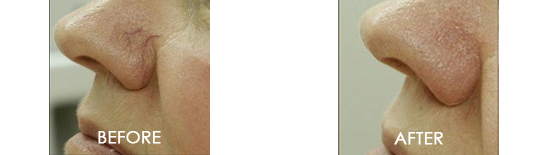 Spider Vein Removal Before After