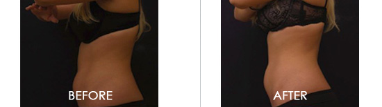Vanquish® ME Before After 01
