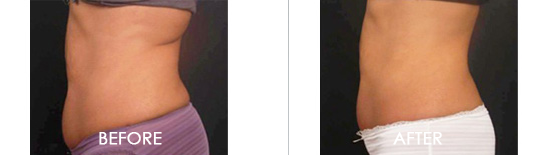Vanquish® ME Before After 02