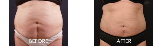 Vanquish® ME Before After 03