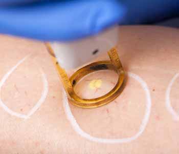 laser vein removal treatment at EsthetixMD Spa & Laser Center in Bend