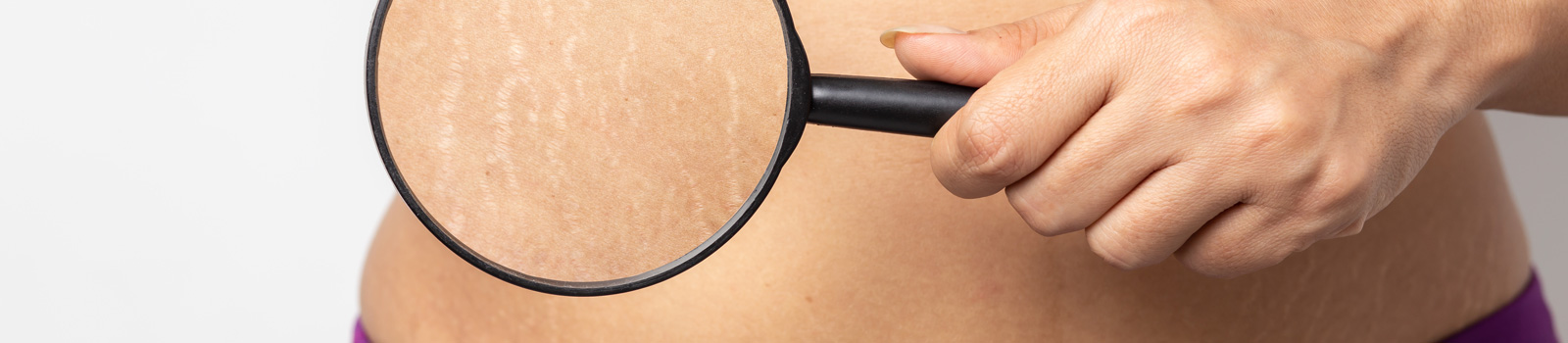 Effective treatment for stretch marks & removal of scars