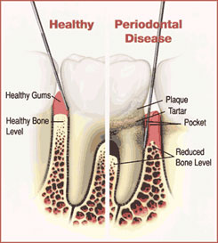 Gum Health Assessment