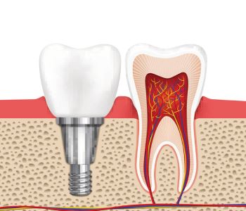 Improve your smile in Sunbury with implant dentistry