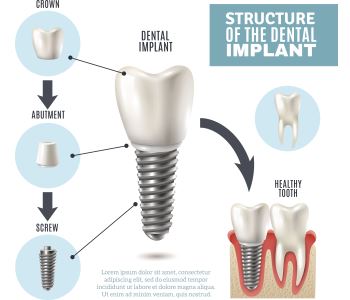 What to expect: Tooth implant procedure in Sunbury