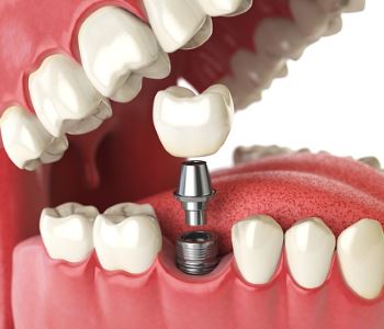 Five things Sunbury residents should know about tooth implant treatment
