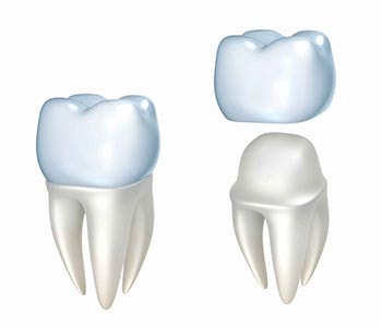 Dr. Frank Rosner Sterling Heights crowns are ideal for strengthening and protecting teeth