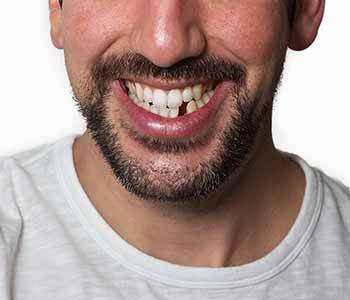 Dental Implants Are Best Option For Patients Who Are Missing Teeth In Toronto