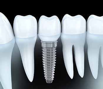 Replacing Missing Teeth With Dental Implants Can Restore Smiles In Toronto