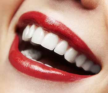 Toronto, On, Teeth Whitening Service Offers Two Ways To Brighten Your Smile