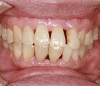 Patients Near Our Vaughan Dental Clinic Learn About Gum Recession