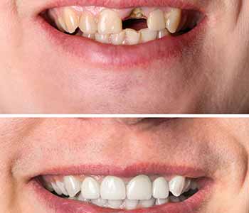Vaughan Dentist Offers Dental Implants To Replace Missing Teeth And Restore Smile